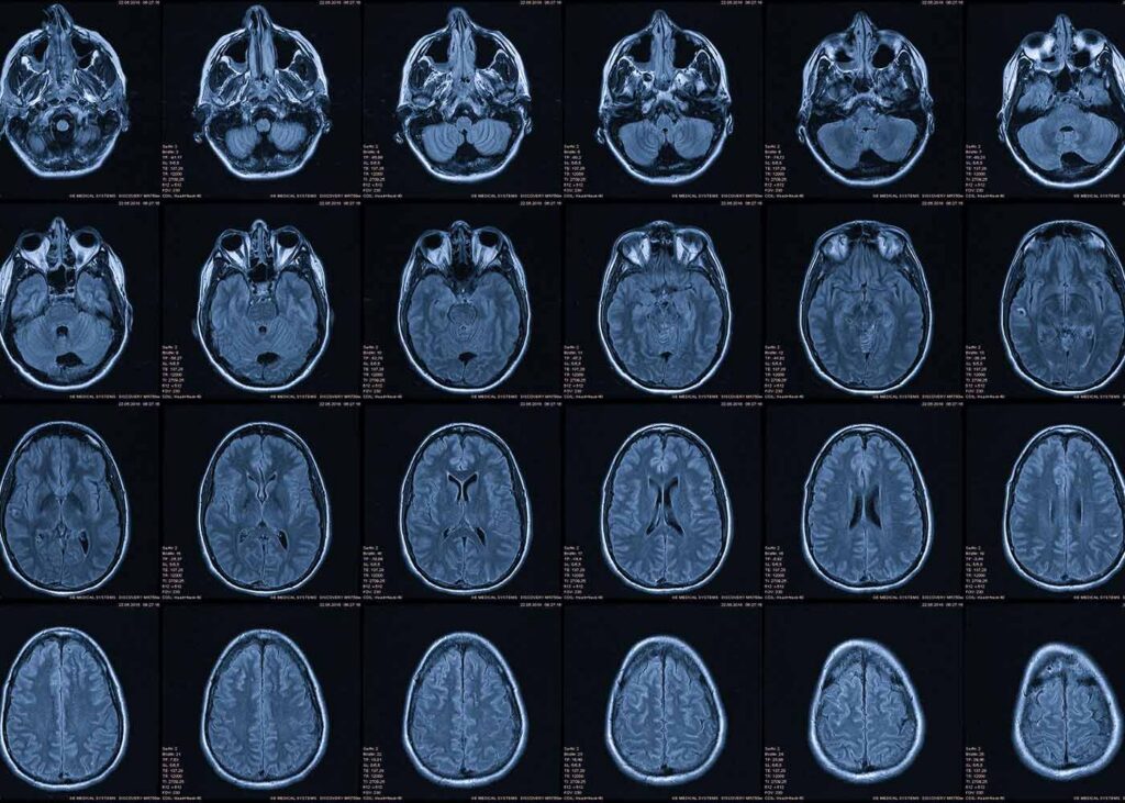 Wet brain syndrome refers to the medical condition Wernicke-Korsakoff syndrome.